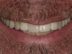 After treatment