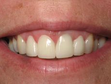 After treatment